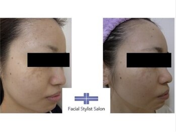 フェイシャルスタイリストサロン 四谷店/ケア例(48)