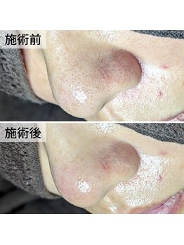 美鼻ラボ 押上 曳舟/黒ずみ毛穴からたまご肌に★