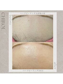 チロル(CHIROL)/ハーブピーリング