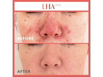 ランソ ビューティー 成田(RUNSO Beauty)/ララピールbefore→after