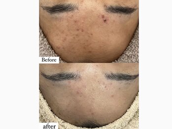 アワピール 成田公津の杜店(AWA PEELL)/ハーブピーリングでニキビケア