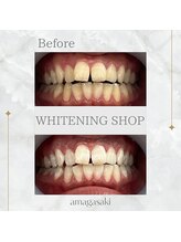 ホワイトニングショップ 尼崎店/セルフホワイトニング1回の効果