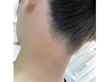 うなじのWAX脱毛で360度、どこから見ても隙の無い美しさを♪