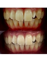 クレン(CLEN)/医療提携ホワイトニング