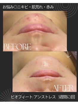 エヌア(nA)/3週間1回クリスティーナエステ♪