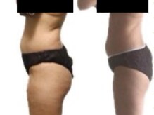 クオッカ(Quokka)の雰囲気(よもぎ蒸し【むくみ改善コース】ビフォーアフター)