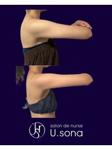 小顔・脂肪コントロール専門 salon de nurse U.sona～松本店～/【痩身】二の腕脂肪分解症例