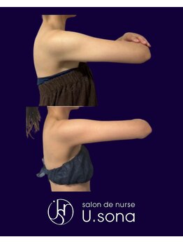 小顔・脂肪コントロール専門 salon de nurse U.sona～松本店～/【痩身】二の腕脂肪分解症例