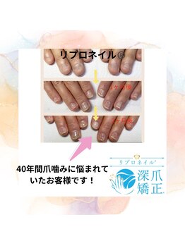 ブルームブルーム(BLOOMブルーム)/40年間爪を噛んでいた