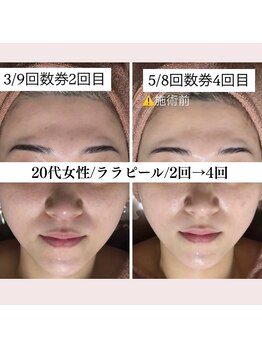 ホワイトアクア 福岡天神店(WHITE AQUA)/ララピールでお肌のくすみ改善!