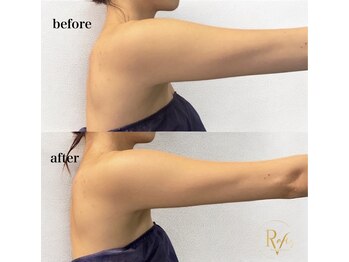 ラヴィス(RAVIS)/どんどん脂肪撃退!