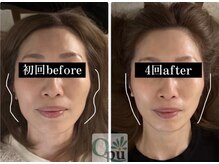 キュープ 鹿児島伊集院店(Qpu)/頬骨がスッキリとしました！