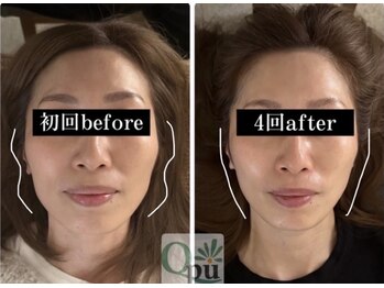 キュープ 鹿児島伊集院店(Qpu)/頬骨がスッキリとしました！