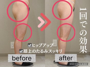 イヨヨ(iyoyo)/【痩身】Before After