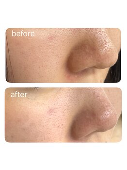 マーレ(Mare)/黒ずみ毛穴ケア