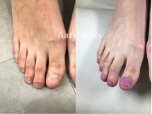アーティネイルズ(Aaty Nails)/【深爪矯正】フット
