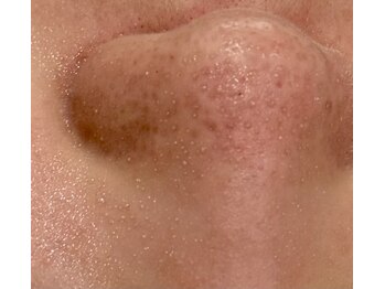 フットミー(foot mii)/ニョキニョキ浮き出る毛穴洗浄