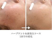 こもれび/１回のお手入れでの変化