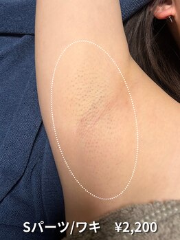 カナウ(KANAU)/【Mパーツ/脱毛】両ワキ