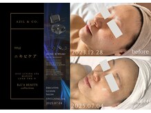 オーヴォ リビングスパ アネックス マノン(OVO LIVING SPA annex MANON)/【施術事例】ニキビケア