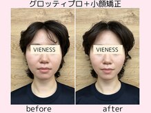 ヴィーネス(VIENESS)/【グロッティプロ＋小顔矯正】