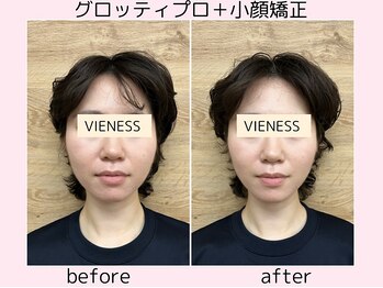 ヴィーネス(VIENESS)/【グロッティプロ＋小顔矯正】