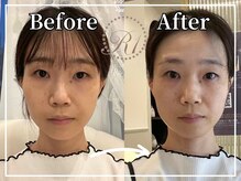 R-1ビューティーサロン 銀座/BEFORE＆AFTER　1回目