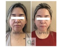 キュープ 下関店(Qpu)/美顔器コース4回での変化