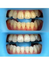 ホワイトニングセンター 富山二口店/富山　二口町ホワイトニング