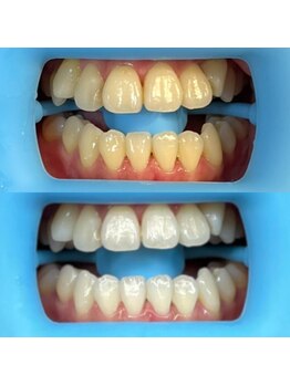 ホワイトニングセンター 富山二口店/富山 二口町ホワイトニング