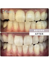 イージーホワイトニング 神戸三宮店(easy whitening)/お客様の症例写真です★