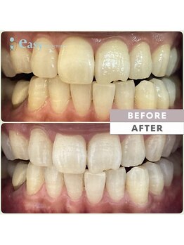 イージーホワイトニング 神戸三宮店(easy whitening)/お客様の症例写真です★