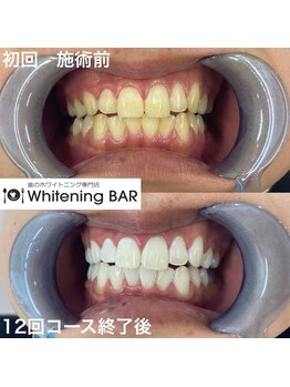 ホワイトニングバー 町田店/12回コース終了ビフォーアフター