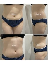 セラス(CERAS)/フォースカッター　お腹30分