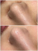 リリー 岐阜店(Lily)/人気の毛穴ケア