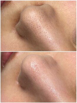 リリー 岐阜店(Lily)/人気の毛穴ケア