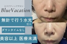ブルーバケーション(Blue Vacation)