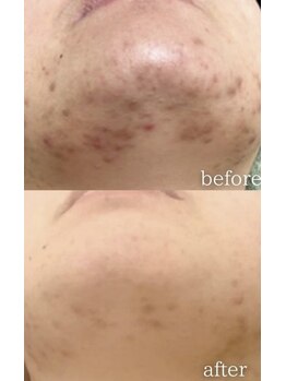 マリエンドリー/ニキビ改善◎