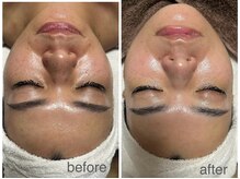 ルーナ(Luna)の雰囲気（【WiQo】肌質改善◎リフトアップハリ艶水光肌　美容液導入）