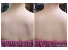 エクラ(Eclat)/Eclatの痩身★BeforeAfter5