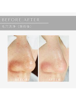 ジール(GIILL)/毛穴洗浄ビフォーアフター