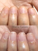 マリーロール 天王寺店(Marie Laure)/深爪矯正/自爪育成/ネイルケア　