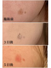 ヴィアージュ(Viage)/シミケア