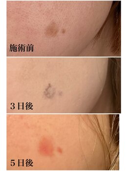 ヴィアージュ(Viage)/シミケア