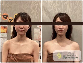 美プレミアム 川越店/360°美顔小顔矯正｜施術結果