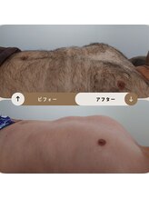 ジュゴン(Dugong)/お腹の脱毛（Before＆After）