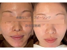 ライフサロン 天神(Life Salon)/剥離なしハーブピーリング