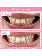 エクシアホワイトニング 熊本下通店/ホワイトニングビフォーアフター
