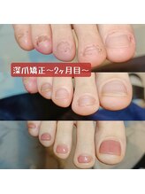 マニエネイル(mani e nail)/フットネイルの深爪矯正