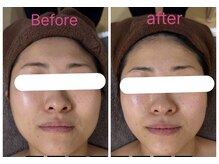 ラヴィエールフローラ(Laviere Flora)/フェイシャルコース